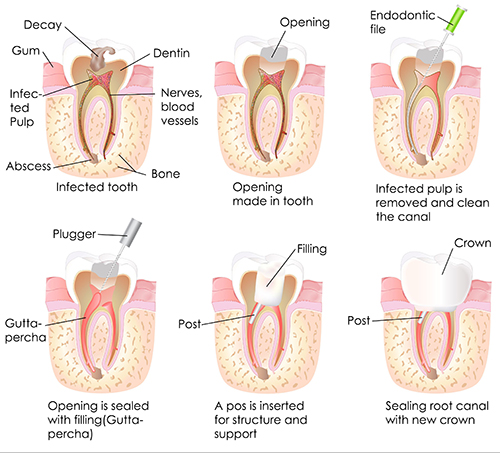 10530 Root Canal