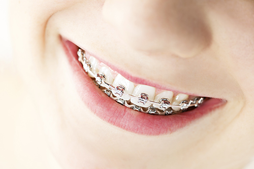 Scarsdale Braces