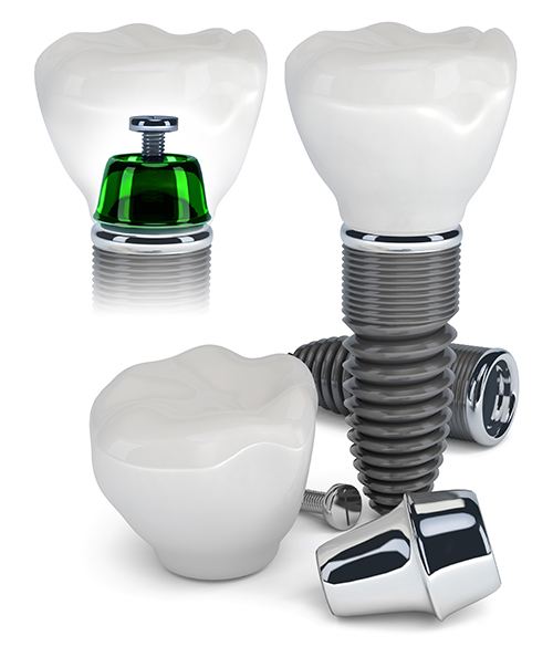 Scarsdale Dental Implant