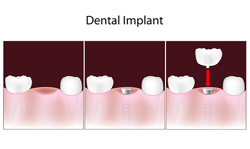 Dental Implant in Hartsdale