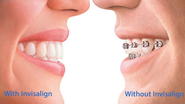 Invisalign Dentist in Hartsdale