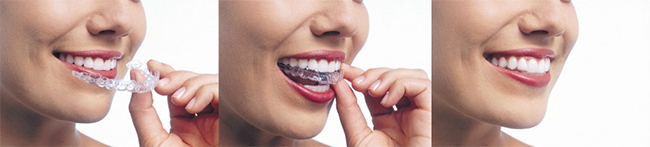 Invisalign Dentist in Scarsdale